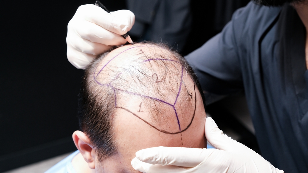 Hair Transplant